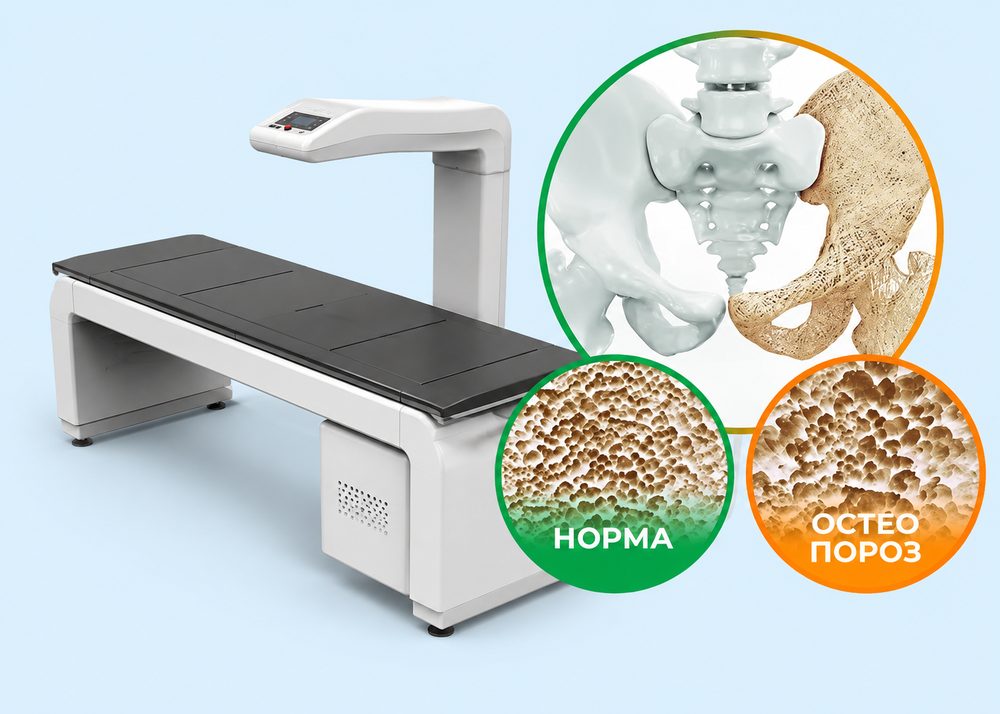 DMS Imaging STRATOS DXA apparati, norma va osteoporoz taqqoslash