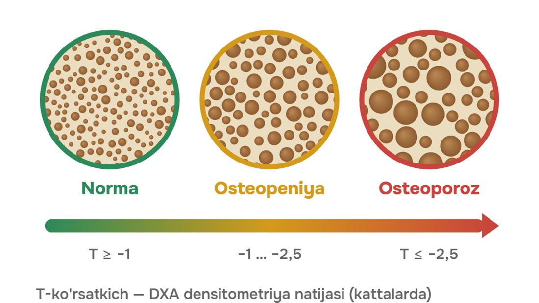 Osteopeniya va osteoporoz: farqi nimada?