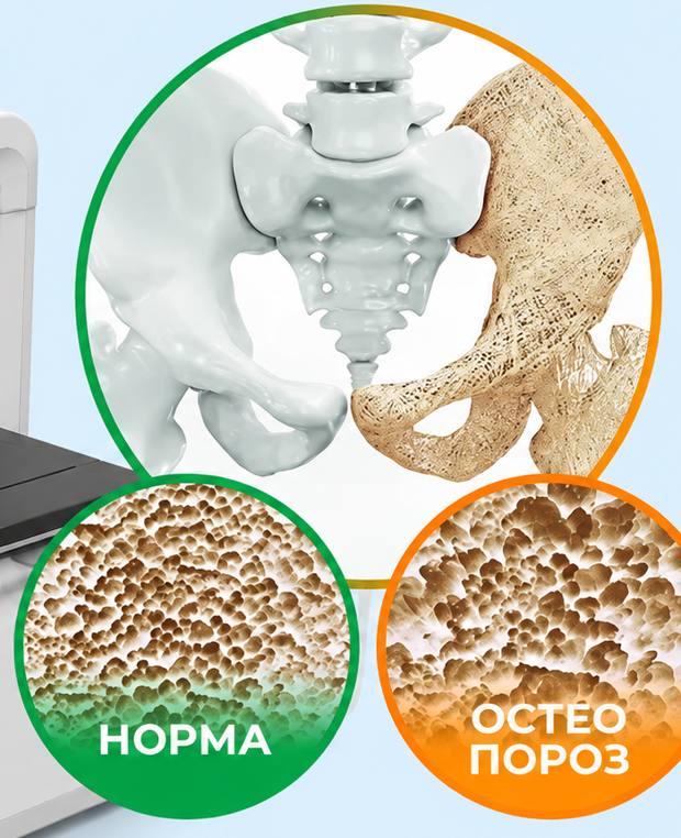 Normal va osteoporotik suyak
